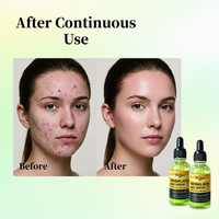 Sérum Visage OEM ODM à l'Acide Azélaïque et Hamamélis, Traitement Anti-Acné, Affinant les Pores, Contrôle du Sébum, Réparation de la Barrière Cutanée, Apaisant, Usage Domestique