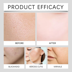 PINNSKIN Kit de Microinfusión Facial con 6 Ampollas de Suero Líquido para Microneedling de 5 ml, Vitamina C, Hidratante, Piel Radiante, Antienvejecimiento - Product Image 4