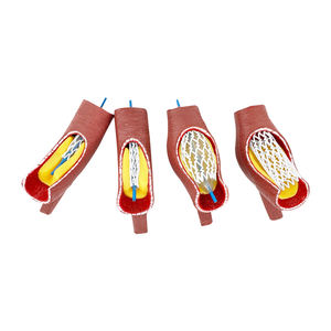 Vaso sanguigno malato modello SMM319 - Product Image 6