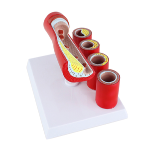 Modello di arteria coronaria cardiovascolare a strati trasparenti con marcatori patologici - Product Image 3