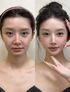 Les nouvelles microsphères PLLA « visage de bébé » de petite taille, procédé de lyophilisation, améliorent la régénération du collagène facial déprimé. - Product Image 4