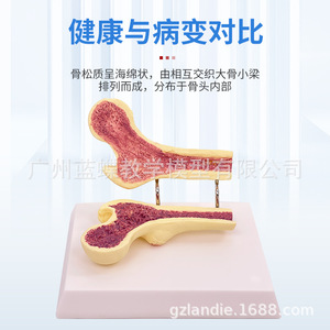 Modèle anatomique d'ostéoporose fémorale humaine, surface anatomique de l'os de la jambe, spécimen de section vertébrale, vertèbre lombaire malade - Product Image 2