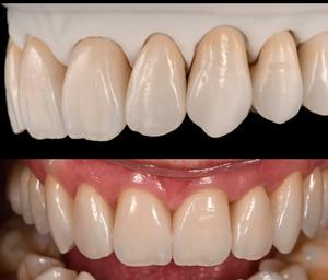 Peralatan gigi portabel profesional-mesin Laser Erbium 980nm 1470nm untuk penghapus plak gigi pemutih gigi Biolaser - Product Image 6