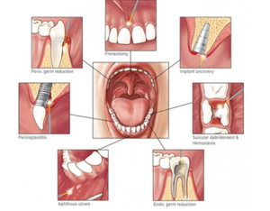 Máquina Láser Diodo Dental Portátil de 980nm y 450nm para Blanqueamiento Dental con Láser de Tejido Blando - Product Image 5