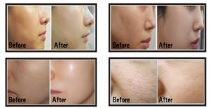 <span class=keywords><strong>Dermaheal</strong></span> Precio de Mayoreo Promoción de Colágeno Ampollas Pink Glow Solución Coreana para el Cuidado de la Piel <span class=keywords><strong>Dermaheal</strong></span> SB - Product Image 3