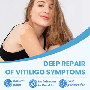 Traitement du <span class=keywords><strong>vitiligo</strong></span> à base de plantes 30ml Vente en gros Soins de la peau Spray dissolvant de taches blanches - Product Image 6