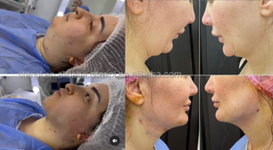 Máquina <span class=keywords><strong>de</strong></span> Láser Diodo para Endolifting Facial <span class=keywords><strong>de</strong></span> 980nm, Tensado <span class=keywords><strong>de</strong></span> <span class=keywords><strong>Piel</strong></span>, Lipo, Papada, Quema <span class=keywords><strong>de</strong></span> Grasa, Lipólisis, Estiramiento Facial, Endolifting, Endoláser - Product Image 5