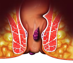 Láser Pilas Cirugía 980nm 1470nm Hemorroides Fístula Anal Proctología Urología 600um Fibra cónica Tratamiento Máquina médica - Product Image 6
