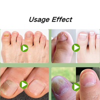 Autocollant correcteur d'ongles incarnés sans colle pour pédicure, kit de manucure et pédicure, réduit la douleur et la pression, traitement des ongles des orteils