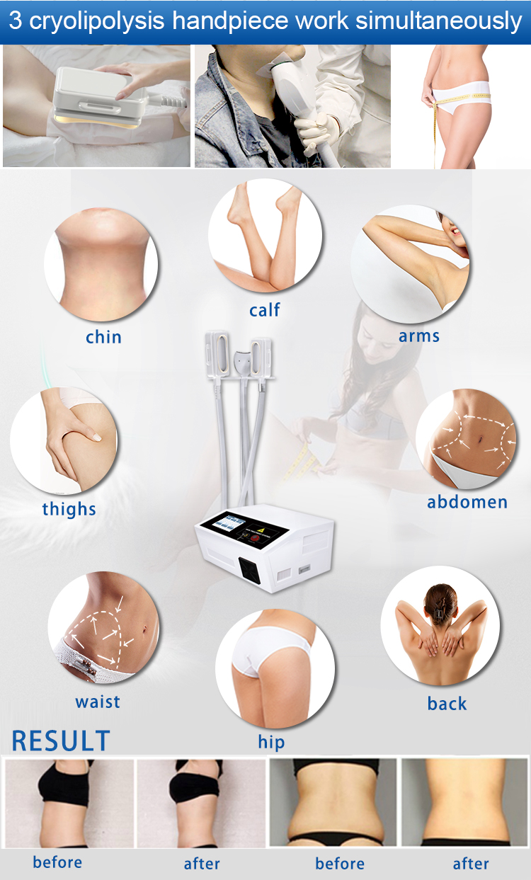 OEM Cellulite Remover Cryolipolysis Slimming Machine 3 Handles Cryolipolysis