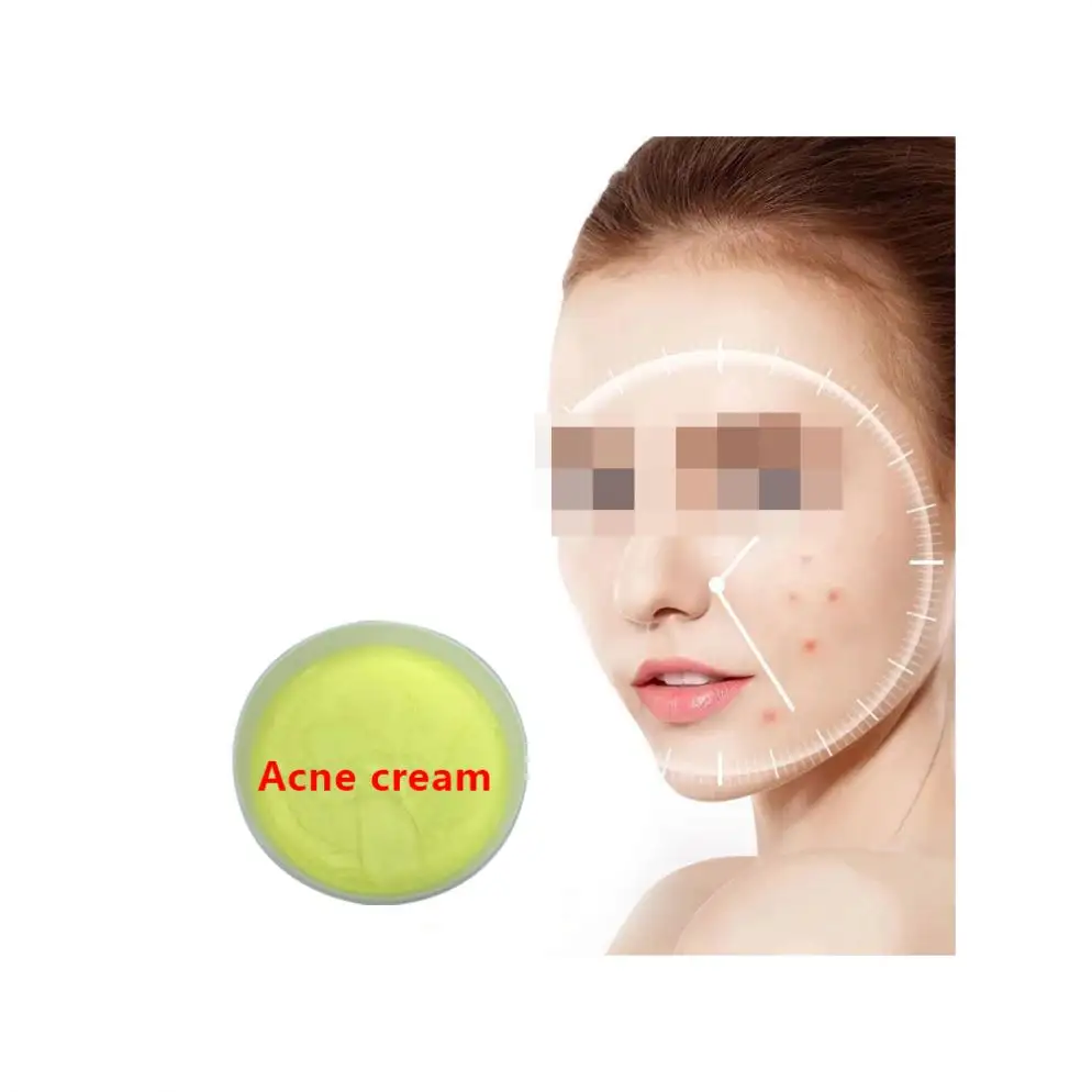 Nha Cung Cap Co Nhieu Khach Hang Nhat Tai Viet Nam trattamento viso per la rimozione dell'acne crema di rimozione del viso di Gel Acne