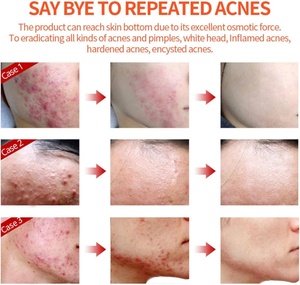 Marque privée Crème Visage Acné Anti Acné Rafraîchissant Contrôle De L'huile De Peau Hydratant Fade Cicatrices Réduire Les Rougeurs D'acné Crème Pour Le Visage - Product Image 6