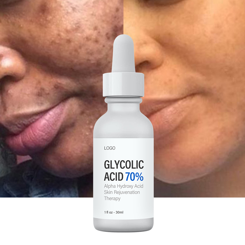 Private Label Glycolic Acid 70% Professional Chemical Peel Serum For Skin Firming