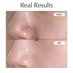 Nuevas Almohadillas Clarificantes de Caroteno para la Piel, Almohadillas Tonificantes Veganas Exfoliantes y Suavizantes Antiacné - Product Image 3