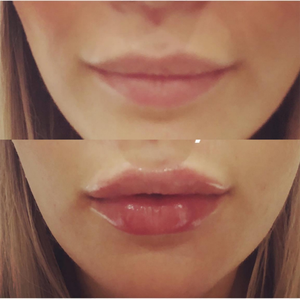 CE Professional Lips Filler 1ml 2ml 3ml 5ml Pure BDDE Cross Linked Hyaluronic Acid Dermal Filler Lip Plump Volume <span class=keywords><strong>Injection</strong></span> - Product Image 4