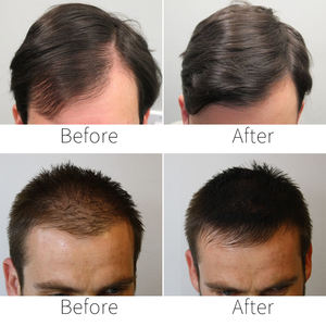 <span class=keywords><strong>DHC</strong></span> ป้องกันการเจริญเติบโตของเส้น<span class=keywords><strong>ผม</strong></span>การรักษา Regrowth <span class=keywords><strong>ผม</strong></span>สเปรย์ที่ซับซ้อน - Product Image 5