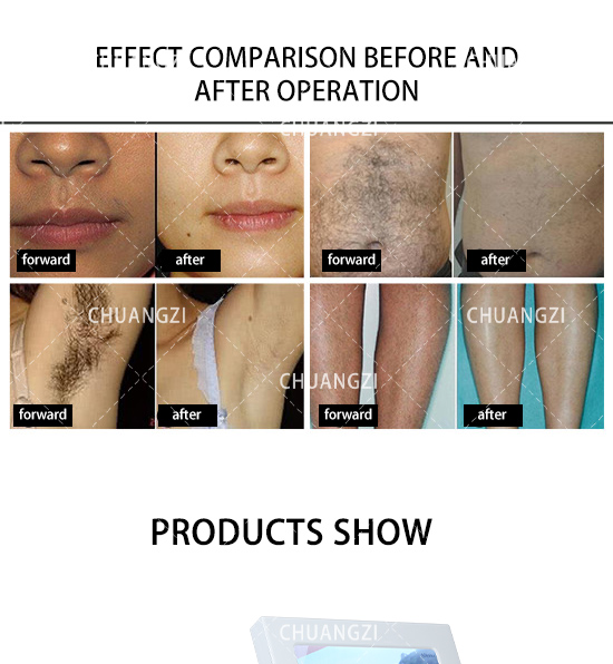 CE Portable 3 Wavelength Diode Laser Pubic Hair Removal Machine 755nm