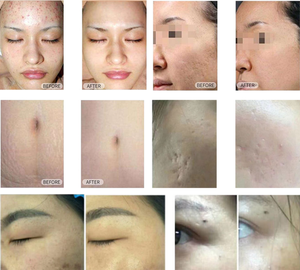 Potente Tratamiento Láser de CO2 para Rejuvenecimiento Facial, 10600nm Semiconductor para Reducir Arrugas, Cicatrices de Acné, Daños Solares y Poros Dilatados - Product Image 6