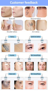 Máquina Portátil de Picosegundos Nd Yag Q-Switched para Eliminación de Tatuajes y Peeling de Carbono - Product Image 6