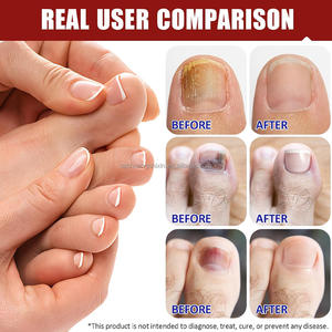 Tempelan korektor kuku jari kaki, pita perawatan kuku jari kaki profesional untuk menghilangkan rasa sakit dan koreksi - Product Image 4