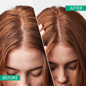 Champú y Acondicionador Personalizados con Romero, Bisabolol, Aceite de Árbol de Té y Menta, Anticaspa, Antifrizz y Suavizante para Cabello Graso - Product Image 4