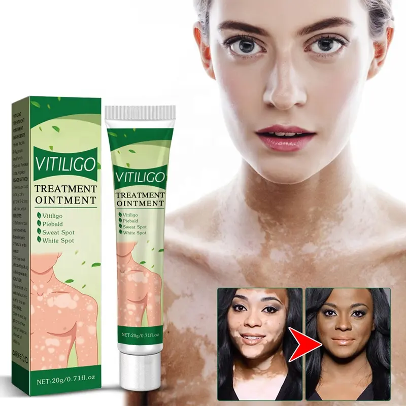 herbal skin care relief spot cream ointment vitiligo cream treatment ointment