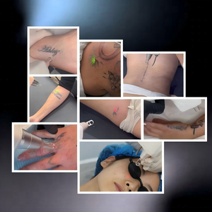 Système Pico multi-longueurs d'onde professionnel, 4 embouts <span class=keywords><strong>pour</strong></span> l'élimination des tatouages, la correction des sourcils, le raffinage des pores et l'éclaircissement, utilisation en salon - Product Image 4