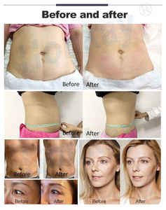 Máquina Profesional de Adelgazamiento Corporal con Terapia Tecar RF de <span class=keywords><strong>448</strong></span> <span class=keywords><strong>KHZ</strong></span>, RET CET, Diatermia 2024 - Product Image 6