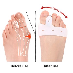 Dispositif SEBS pour <span class=keywords><strong>hallux</strong></span> <span class=keywords><strong>valgus</strong></span> chez l'adulte avec semelles orthopédiques pour la séparation quotidienne des orteils - Product Image 4