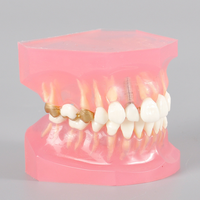 Modelo de Tratamiento de Caries con Puente de Caries e Implante