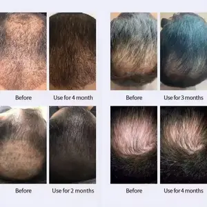 60ml Anti pérdida de cabello aceite de crecimiento rápido del cabello OEM ODM 5% suero de tratamiento de crecimiento del cabello para mujeres y hombres