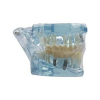Modelo de Restauración Dental de PLA Transparente Azul para Enseñanza Oral, Marca Tianlian, Modelo TL
