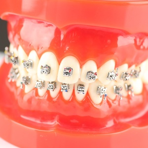 Guber tự ligating chỉnh nha khung <span class=keywords><strong>0.22</strong></span> <span class=keywords><strong>Roth</strong></span> niềng răng và răng khung đa mục đích vật liệu vệ sinh răng miệng - Product Image 2