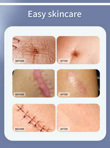 Feuille de dissolvant de cicatrices de chirurgie personnalisée OEM ruban de <span class=keywords><strong>cicatrice</strong></span> en silicone pour abdominoplastie ruban de dissolvant de <span class=keywords><strong>cicatrice</strong></span> d'avène <span class=keywords><strong>cicalfate</strong></span> - Product Image 5