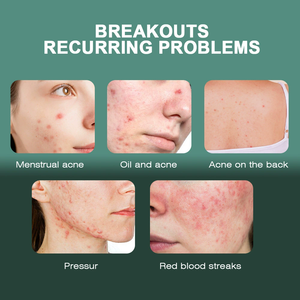 Crème Soin Anti-Acné Nourrissante Hydratante Visage Estompe les Cicatrices de Boutons - Product Image 6