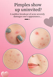 แผ่นแปะสิวไฮโดรคอลลอยด์กันน้ำ ผลิตจากโรงงาน ขายส่ง รับผลิตแบรนด์ส่วนตัว ผสมกรดและน้ำมันทีทรี ปิดสิว รอยสิว - Product Image 4