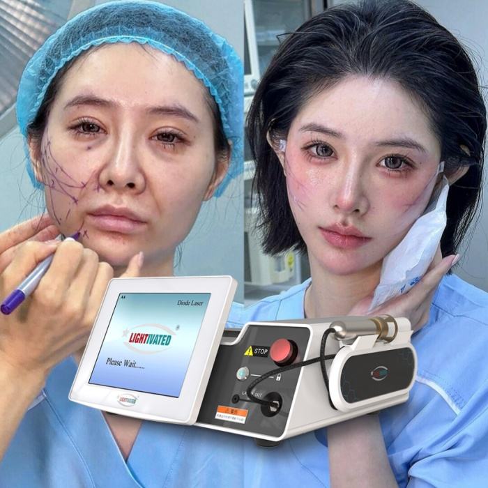 Best Selling Liposuction Machine 1470nm Laser Fat Removal Device - Main Image