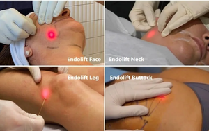 Mesin Endo Laserlift portabel, 980nm 1470nm Laser sedot lemak untuk operasi vaskuler & penghilang lemak kehilangan lemak - Product Image 3