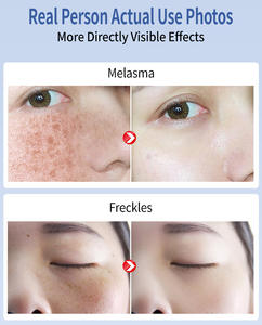 Crème Visage Intensive Anti-Taches Brunes, Correcteur de Taches de Rousseur, Éclaircissante, Traitement Anti-Pigmentation et Anti-Melasma, <span class=keywords><strong>Peeling</strong></span>, kg - Product Image 5