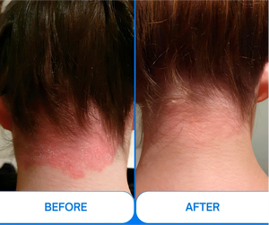 Nueva Llegada Península <span class=keywords><strong>L</strong></span> ED Excimer Vitiligo LED 308nm Excimer Laser 308nm UVB PARA EL Hogar Psoriasis Tratamiento Uvb Fototerapia - Product Image 5