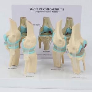 Modelo de articulación de rodilla humana de 4 etapas con tarjeta posterior, recurso didáctico de esqueleto de rodilla, modelo de articulación de rodilla con patología. - Product Image 4