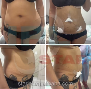 980nm Endoskin lazer lipoliz diyot lazer Endo lazer makinesi Liposuction makinesi yağ erime makinesi - Product Image 4