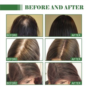 Nouelv Aceite de Batana 100% Puro y Orgánico - Tratamiento Natural para el Crecimiento del Cabello, para un Cabello Más Grueso y Voluminoso y Nutrición del Cuero Cabelludo - Product Image 4