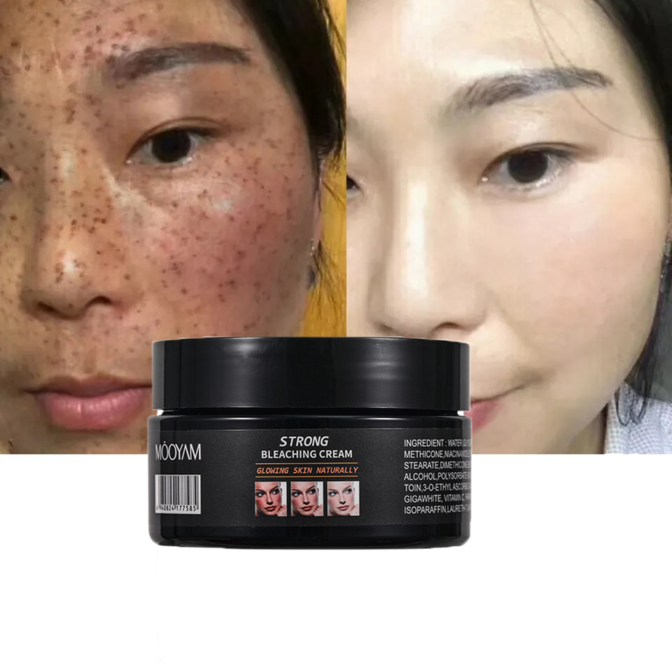 120g Pimples Melasma Blemish Removal Dark Spot Remover Cream Strong Bleaching Whitening Face Freckles Remove Corrector Cream