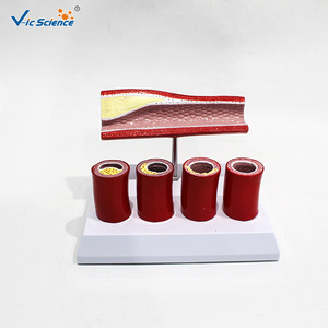 Modelo anatómico cardiovascular; estructura del trombo de la aterosclerosis de las arterias coronarias; muestra de demostración para el aula de medicina. - Product Image 1