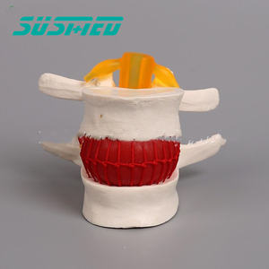 Modèle de démonstration de hernie discale lombaire humaine modèle d'enseignement de l'anatomie de la pathologie discale - Product Image 5