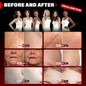 Máquina fraccional de láser CO2 Perfectlaser, precio profesional, eliminación de cicatrices, cuidado de la piel, belleza, ajuste Vaginal, Fotona, láser CO2 - Product Image 5