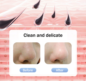 Removedor de Puntos Negros, Tratamiento para el Acné, Limpiador Facial y Nasal, Limpieza Profunda al Vacío, Venta al Por Mayor - Product Image 5