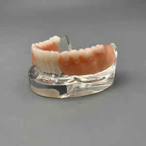 แบบจำลองการใส่รากฟันเทียมแบบถอดได้สำหรับการสาธิตทางทันตกรรมและการสื่อสารกับผู้ป่วย - Product Image 6