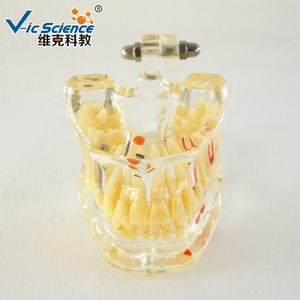 Modèle <span class=keywords><strong>dentaire</strong></span> scientifique médical avec dent manquante pour la formation dans les écoles et les hôpitaux - Vic Science - Product Image 6